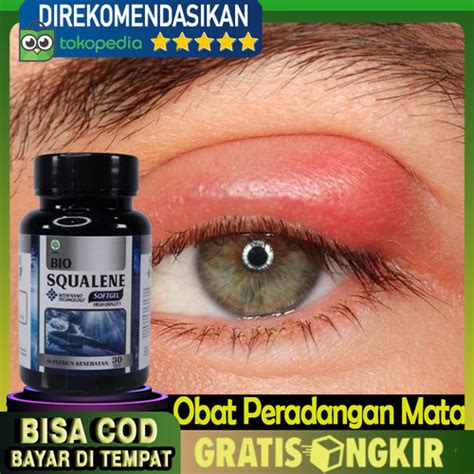 Jual Biosqualene Softgel Obat Blefaritis Peradangan Kelopak Mata