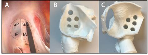 Transseptal Puncture A Step By Step Procedural Guide Cardiac