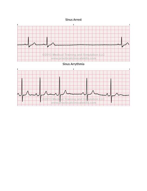 Solution Ekg Strips Docx Studypool