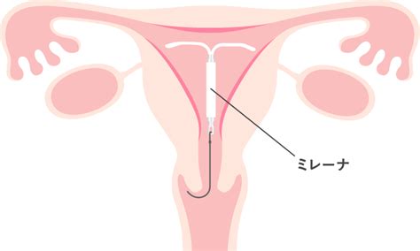 子宮内避妊用具 江東区の産婦人科｜ベビースマイルレディースクリニック有明