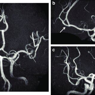 (a) MRA shows an aneurysm of the MCA at the left bifurcation (long... | Download Scientific Diagram