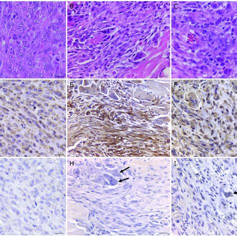 Nomenclature and histological features of malignant fibrous ...