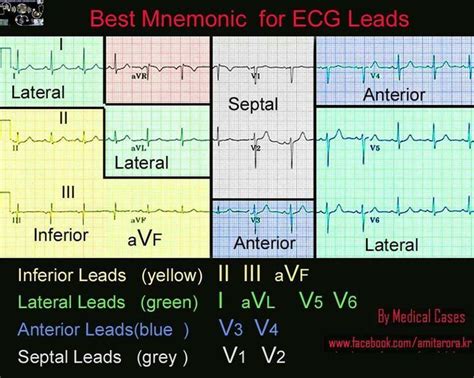 ECG Nursing Mnemonics Bing Images Nursing Pinterest Nursing