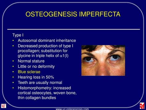 PPT - SECONDARY CAUSES OF OSTEOPOROSIS PowerPoint Presentation, free download - ID:466568