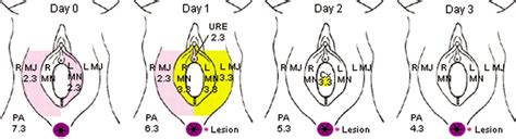 Genital Herpes Simplex Type 2