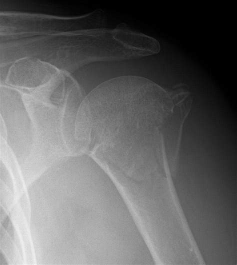 Valgus Impacted Fracture Of The Proximal Humerus Journal Of Hand Surgery