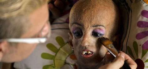 Progeria Expectativa De Vida - Expectativa De Vida Na Progeria