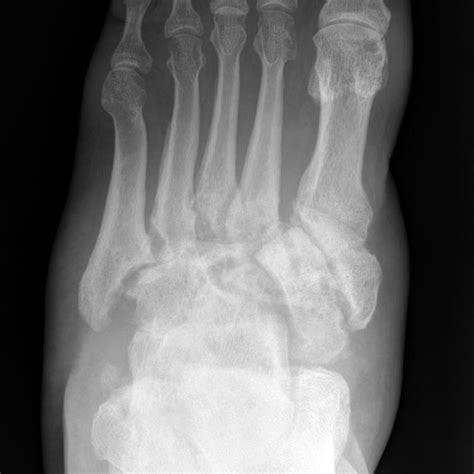 Lateral dislocation of the 2nd to 5th tarsometatarsal joints. Severe ...