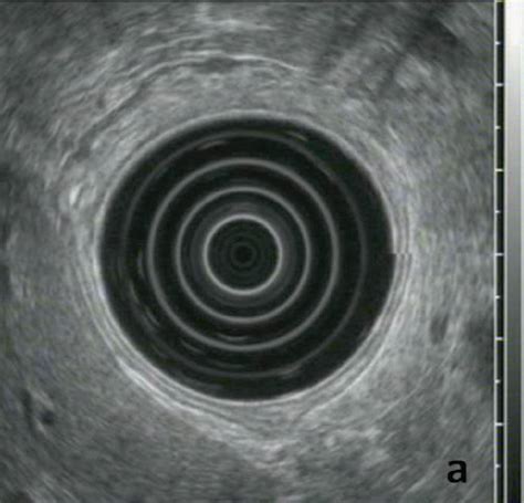 A Radial Eus Imaging Of The Gastric Wall Notice The Normal 5 Layer Download Scientific