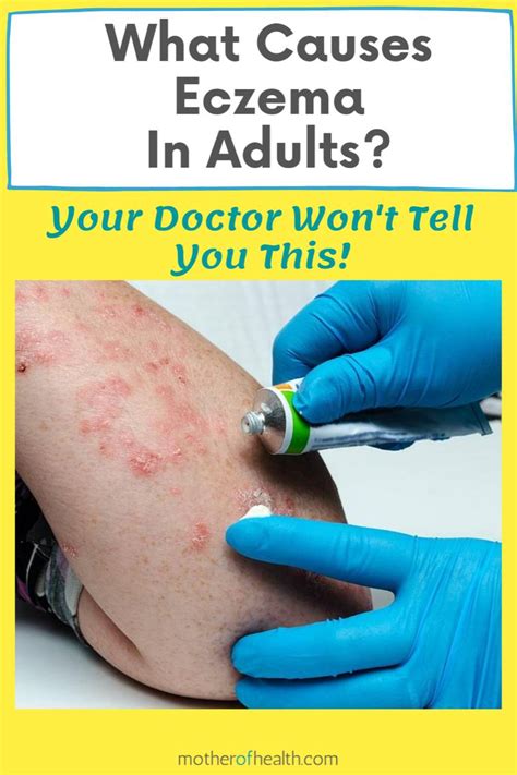 What Causes Eczema In Adults Mother Of Health