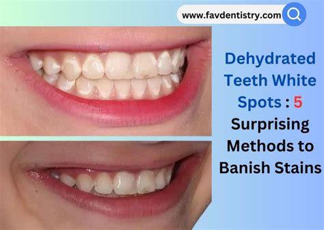 What Do Dehydrated Teeth Look Like Unveiling The Disturbing Truth