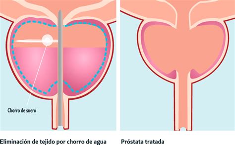 El Sistema AquaBeam Urologia La Moraleja