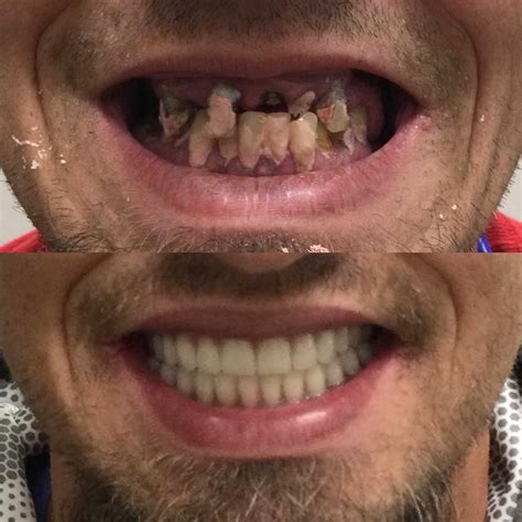 Memphis Dentures and Implants