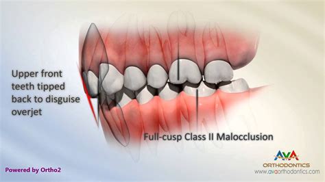 Malocclusion Class Ii Div 2 Youtube