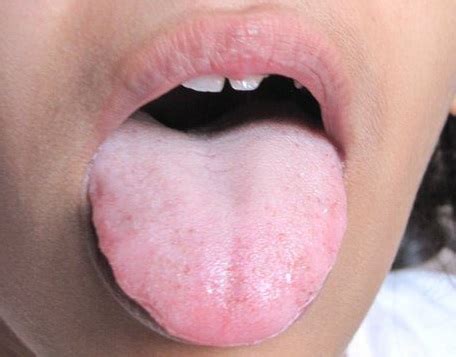 8 Great Home Remedies For Coated Tongue - Home Remedies For All Kinds ...