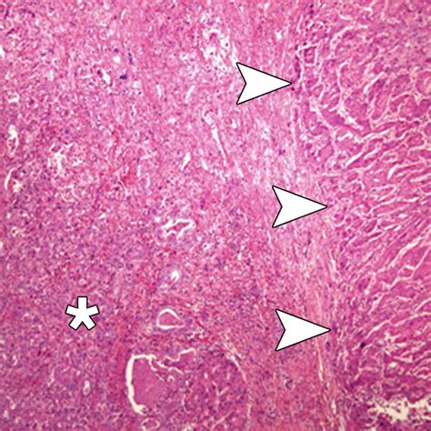 Hepatocellular Carcinoma Variants Radiologic Pathologic Correlation Ajr