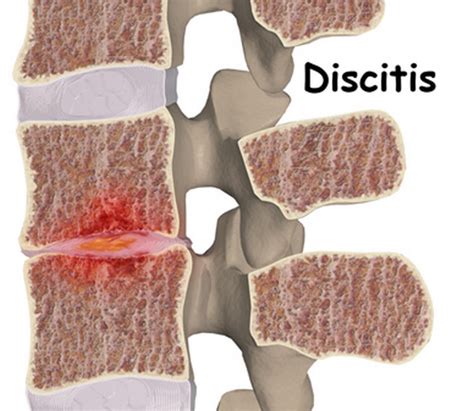 Discitis | Current Health Advice, Health Blog Articles and Tips