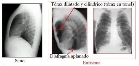 Enfisema Pulmonar Causas Y Diagnóstico