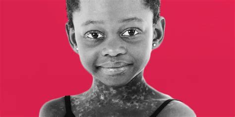 Michaela Deprince The Girl Who Nearly Starved To Death In Childhood