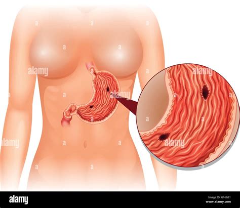 Stomach Ulcer Diagram In Woman Illustration Stock Vector Image Art