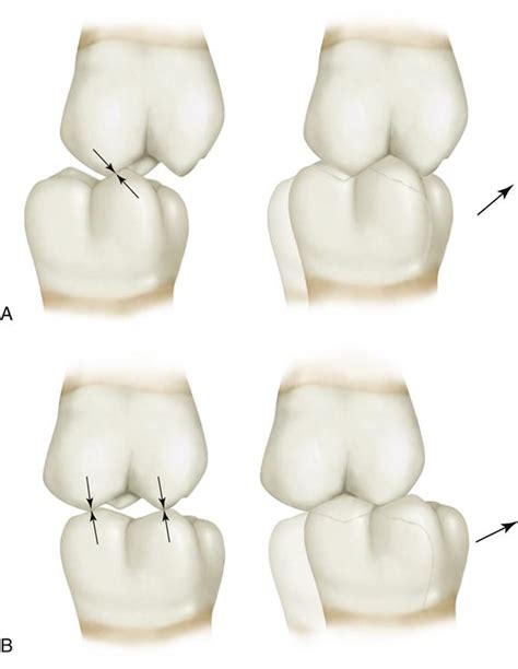 19. Selective Grinding | Pocket Dentistry