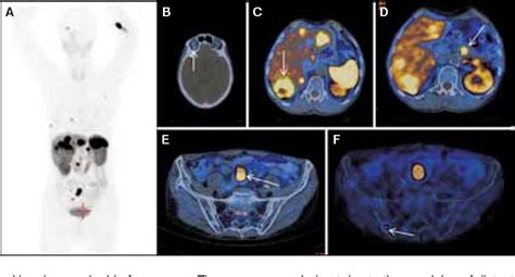 PDF The Diagnostic Role Of 68Ga DOTATATE PET CT In The Detection Of