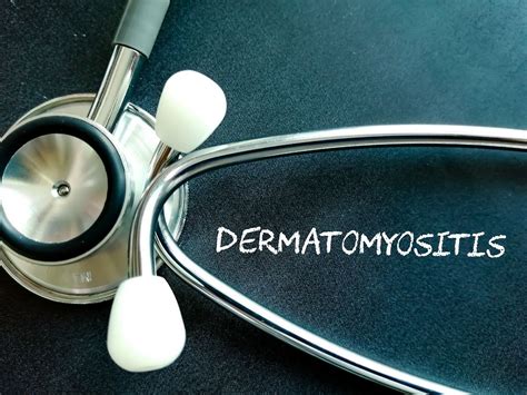 Dermatomyositis: Symptoms, Causes, Diagnosis, and Treatment