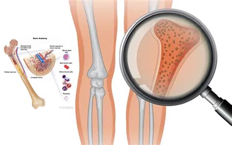 IBMFS Inherited Bone Marrow Failure Syndromes treatment