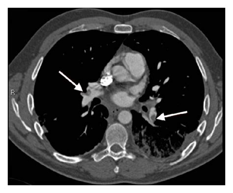 CT Pulmonary Angiography CTPA Showinga Bilateral Pulmonary Embolisms