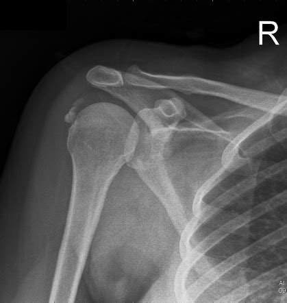 Calcific Tendinopathy Of The Rotator Cuff Radiology Case