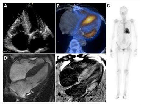 Multimodality Imaging Of A Patient With Clinical Features Of Cardiac