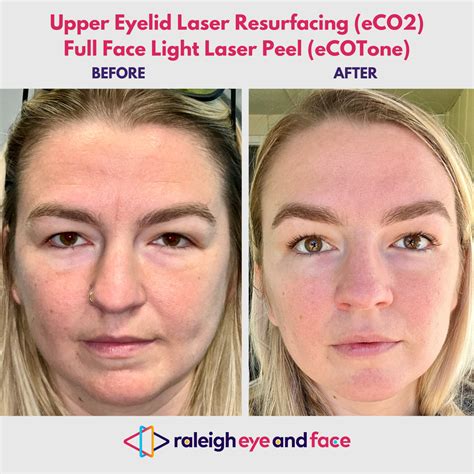 Top Rated Co2 Laser Skin Resurfacing In Raleigh — Raleigh Eye And Face