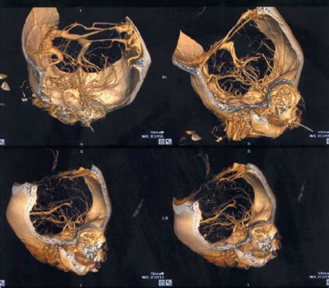 Reconstruction Of Head Ct Angiography The Images Demonstrate That One