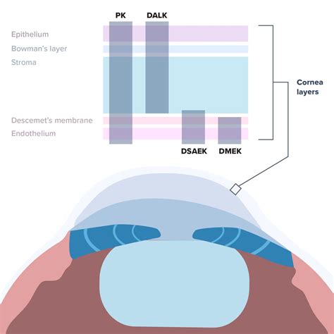 Cornea Transplant Dallas, TX - Fort Worth - Plano - Cornea Associates ...