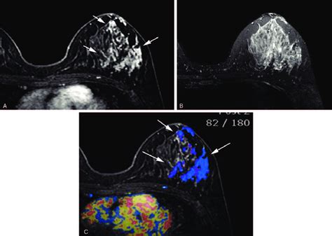 A 50 Year Old Woman With Ductal Carcinoma In Situ Dcis In Her Left