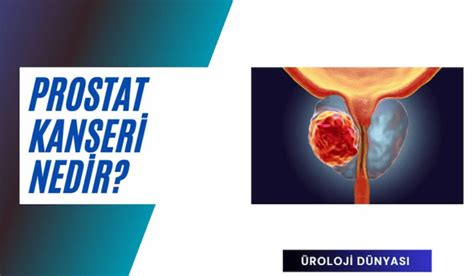 Prostat kanseri belirtileri 6 farklı tedavi yöntemi