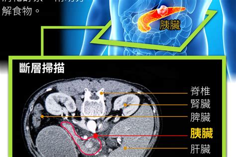 【圖解癌王】胰臟癌隱藏深處 悄然奪命 Line Today Line Today