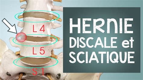 Hernie Discale Douleur Et Sciatique Tout Savoir Pour Un Soulagement