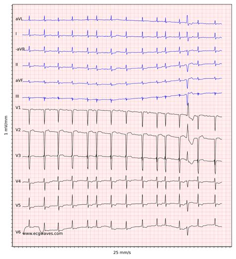 Ecg Atrial Fibrillation Anteroseptal Myocardial Infarction Ventricular Premature Complex Non