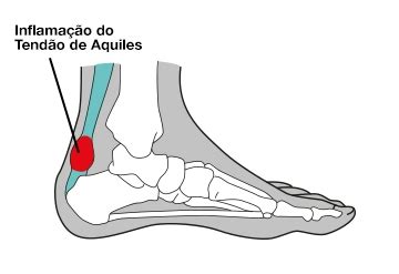 Dor No Tend O De Aquiles Causas E Tratamentos