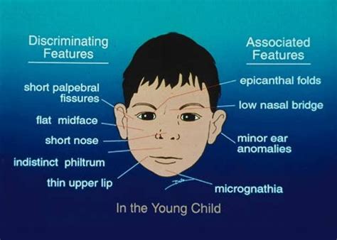 signs and symtoms - microcephaly