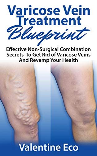 Varicose Vein Treatment Blueprint Effective Non Surgical Combination