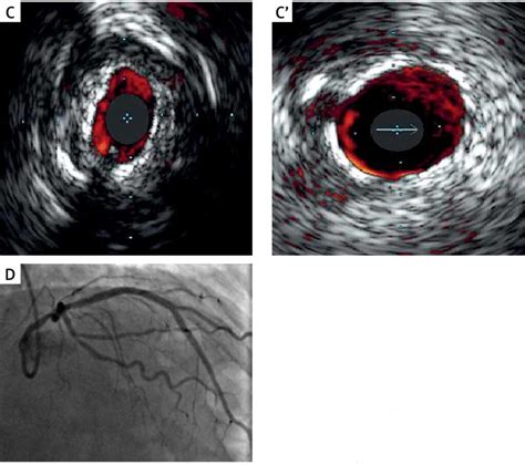 Intravascular Ultrasonography Guided Mm Long Drug Eluting Tapered