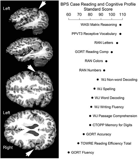 Figure 1 From Case Of Bilateral Perisylvian Syndrome With Disability