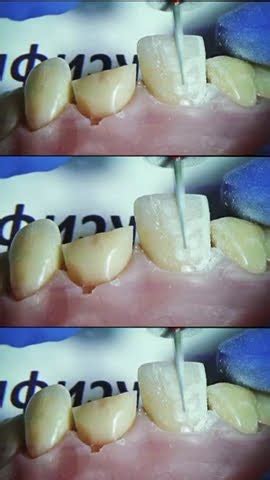 Композитные Блич Виниры. 2-х дневная Практика от Клыка до Клыка - YouTube