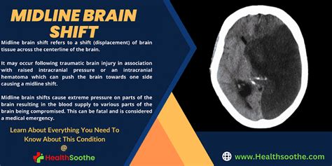 Midline Brain Shift | What You Need to Know About This Condition (with Pictures, Videos & FAQS ...