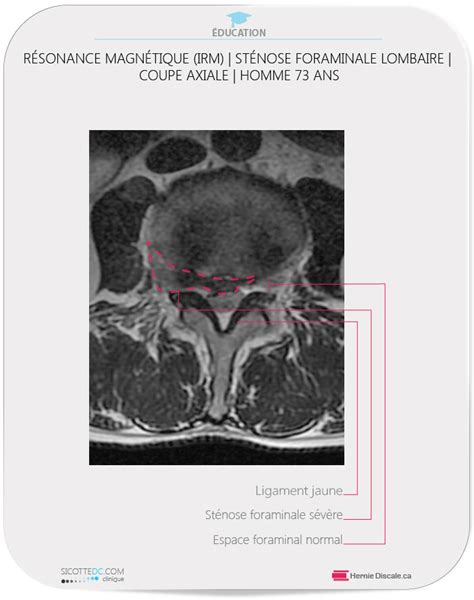 St Nose Foraminale Lombaire