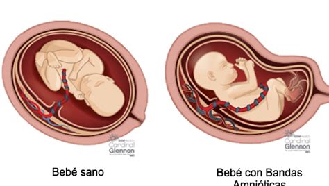 Qu Es Una Brida Amni Tica Descubre C Mo No Afecta Al Feto