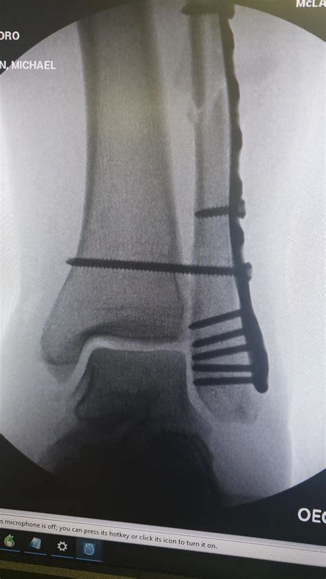 Discover more like Brokenbones: My trimalleolar fracture repaired! Doc