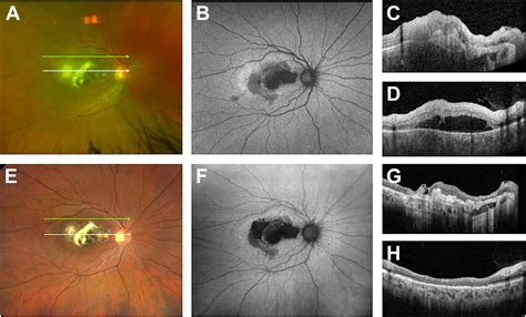 Multimodal Imaging In Infectious Uveitis Advances In Ophthalmology